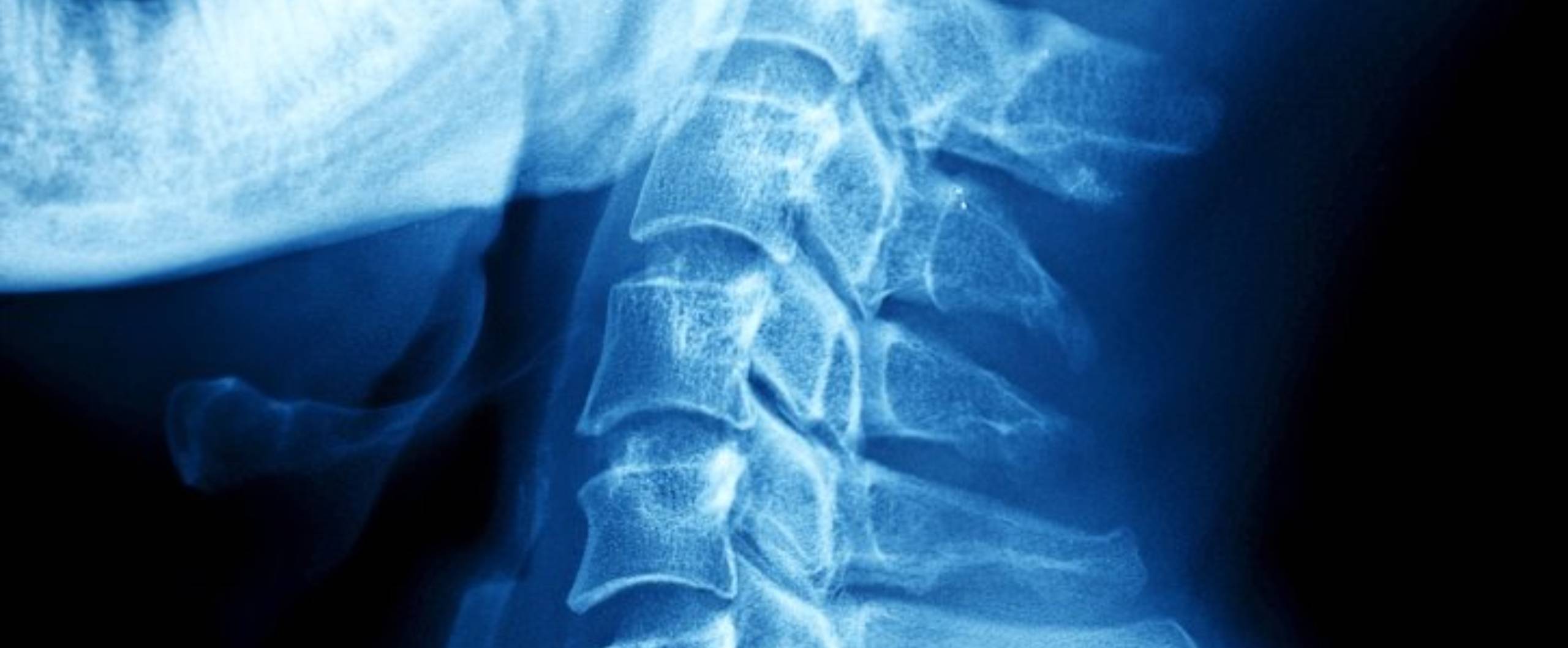 Workers Comp for Neck Injury Omaha NE