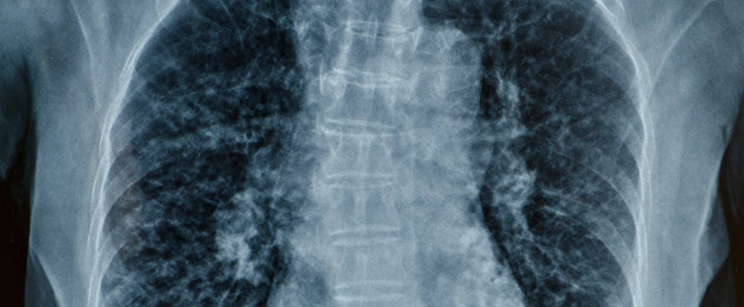 Spinal Cord Injury from an Omaha Car Accident