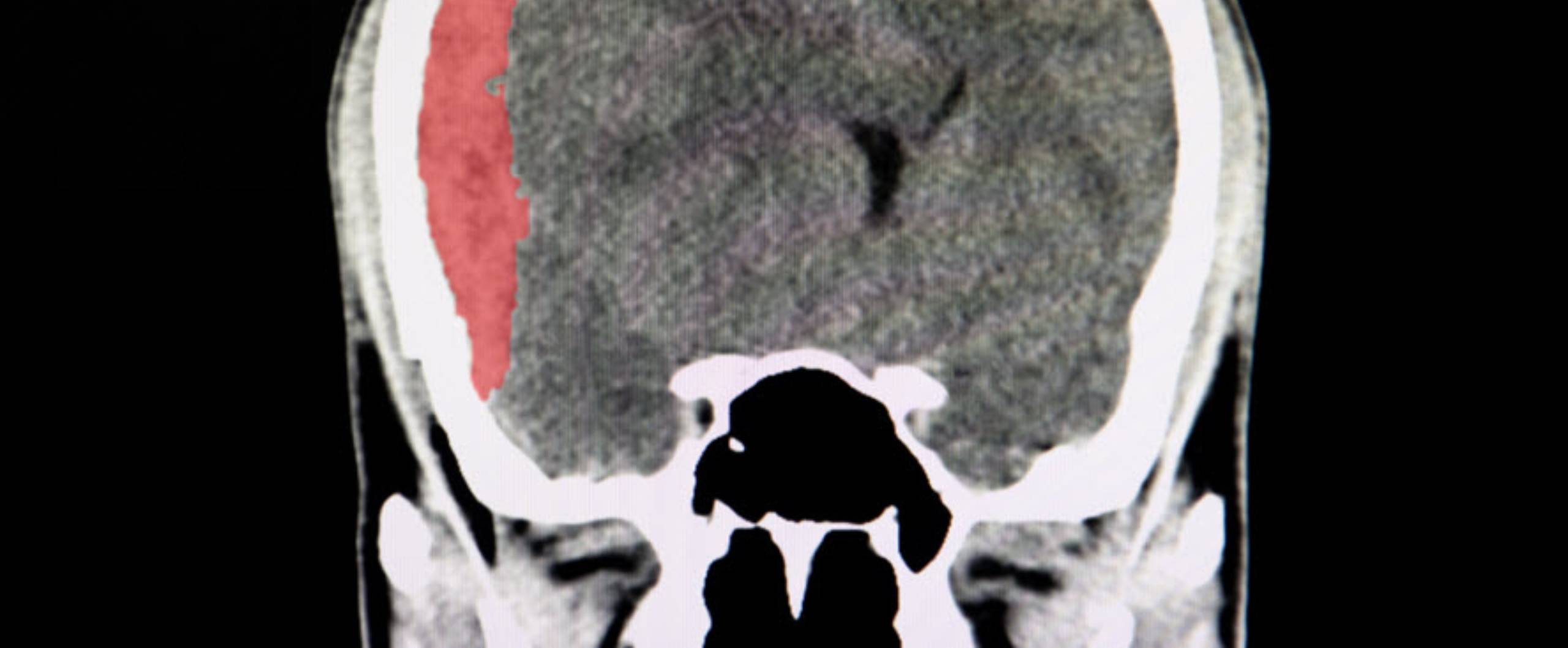 Brain Injuries from a Work Accident