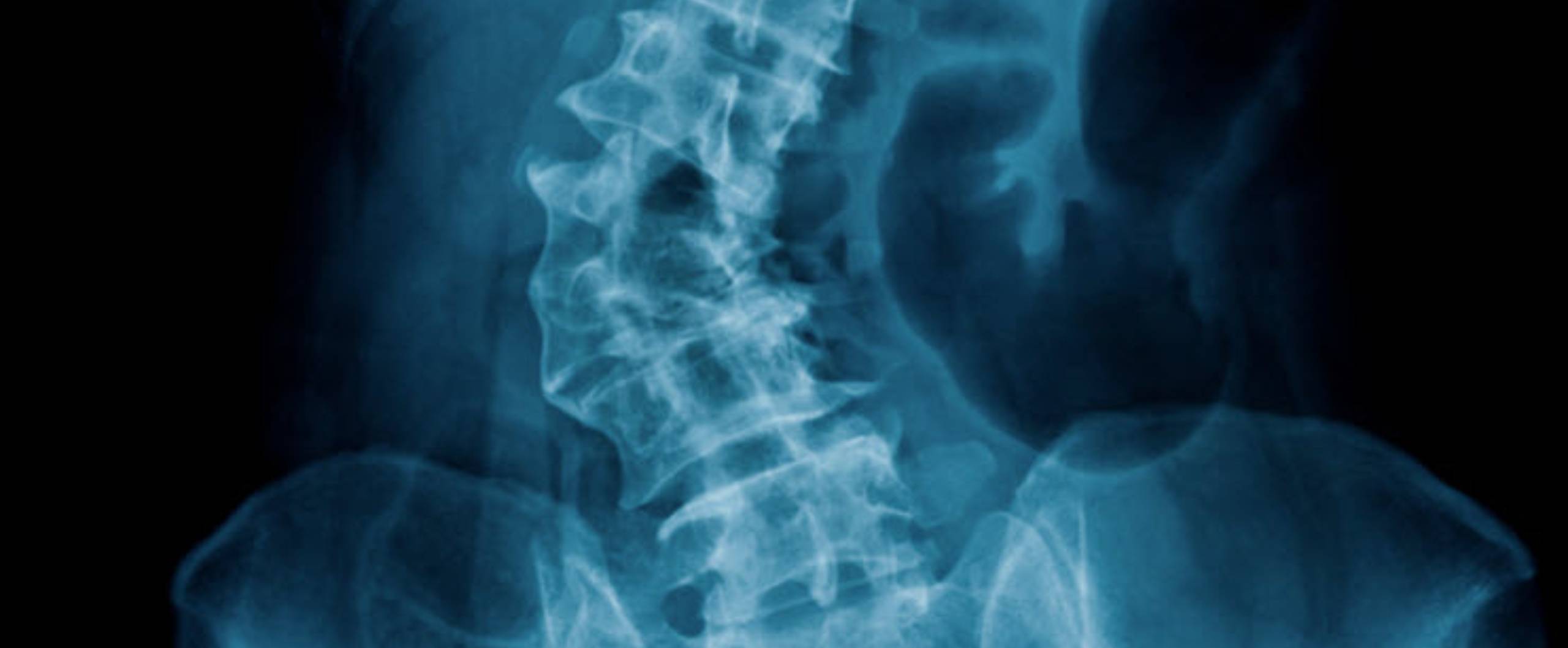 Personal Injury from a Car Accident