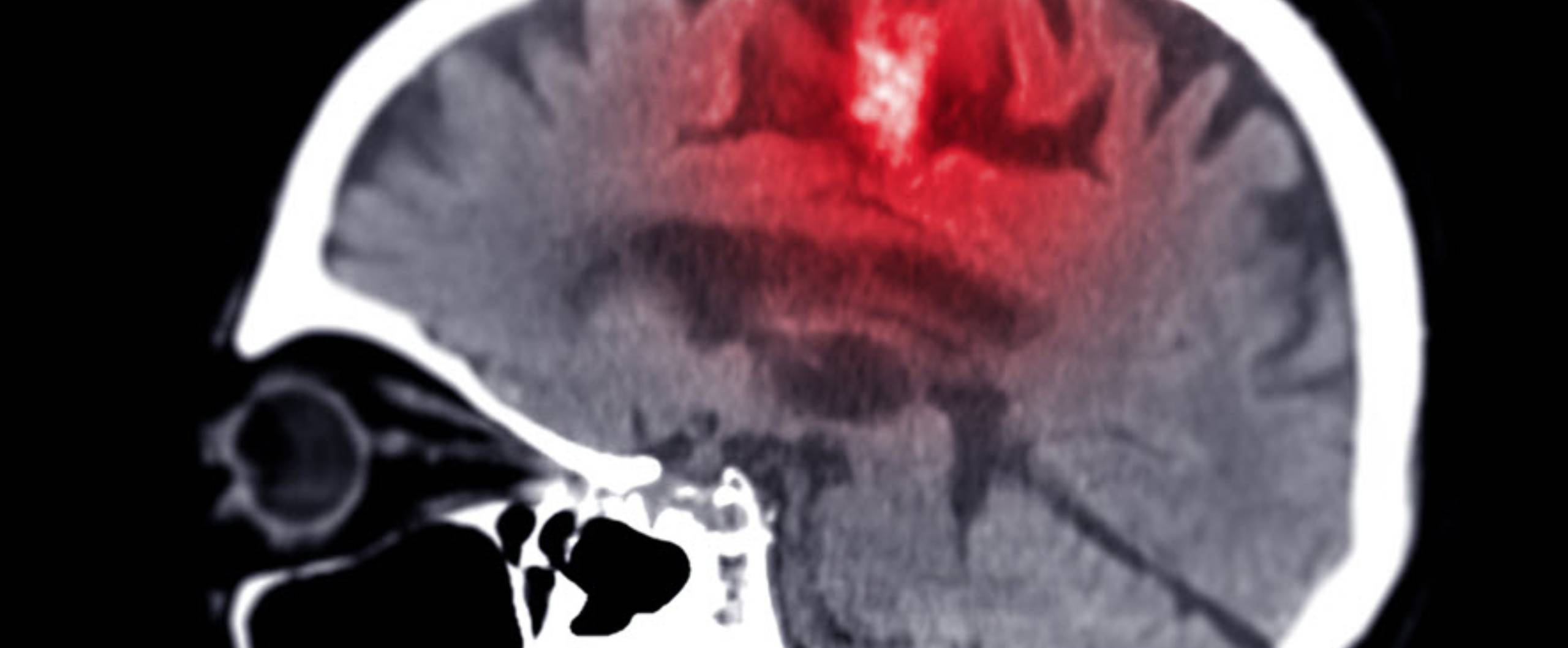Find a Brain Injury Attorney in Omaha Nebraska