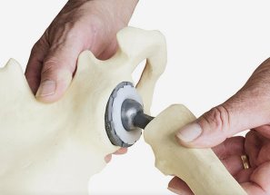 Hip Implant Failure Attorneys